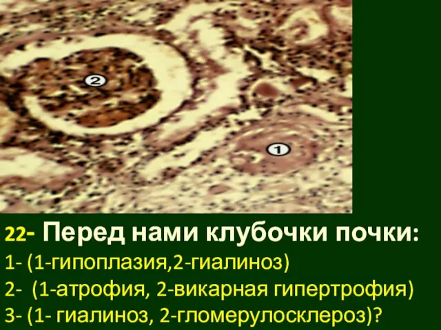 22- Перед нами клубочки почки: 1- (1-гипоплазия,2-гиалиноз) 2- (1-атрофия, 2-викарная гипертрофия) 3- (1- гиалиноз, 2-гломерулосклероз)?