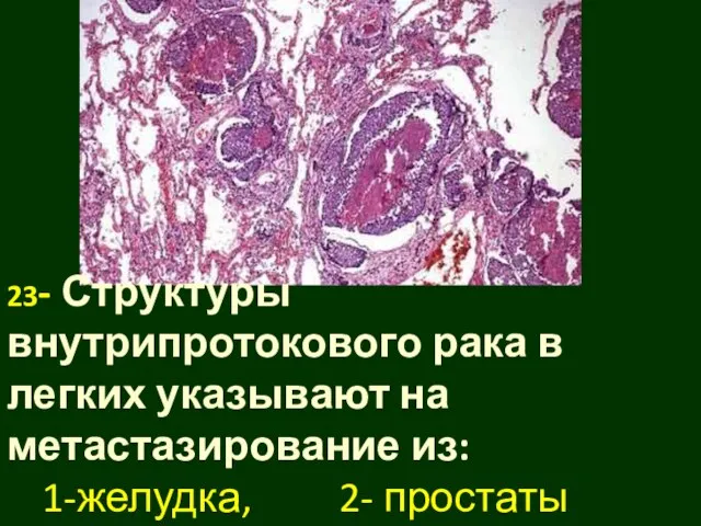23- Структуры внутрипротокового рака в легких указывают на метастазирование из: 1-желудка, 2- простаты 3-молочной железы?