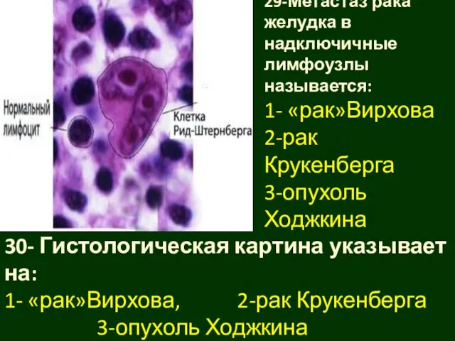 29-Метастаз рака желудка в надключичные лимфоузлы называется: 1- «рак»Вирхова 2-рак Крукенберга 3-опухоль