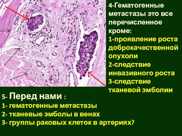 4-Гематогенные метастазы это все перечисленное кроме: 1-проявление роста доброкачественной опухоли 2-следствие инвазивного