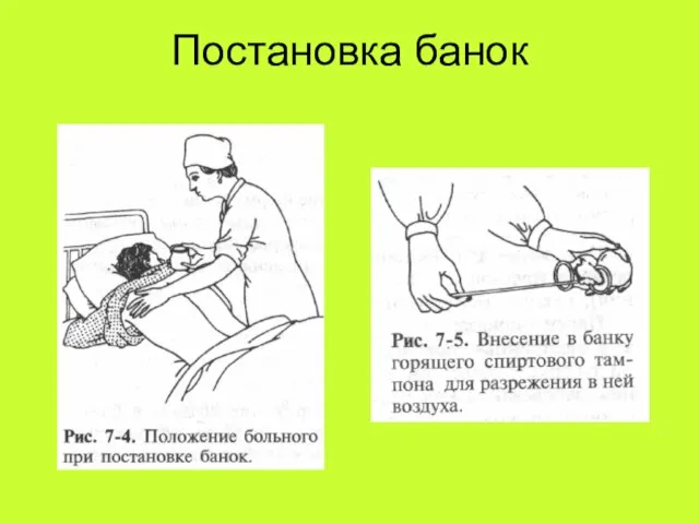 Постановка банок