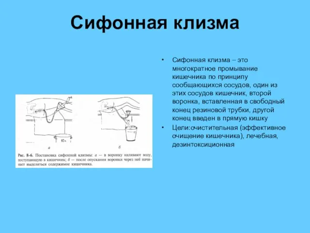 Сифонная клизма Сифонная клизма – это многократное промывание кишечника по принципу сообщающихся