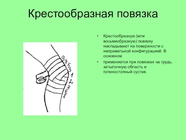 Крестообразная повязка Крестообразную (или восьмиобразную) повязку накладывают на поверхности с неправильной конфигурацией.