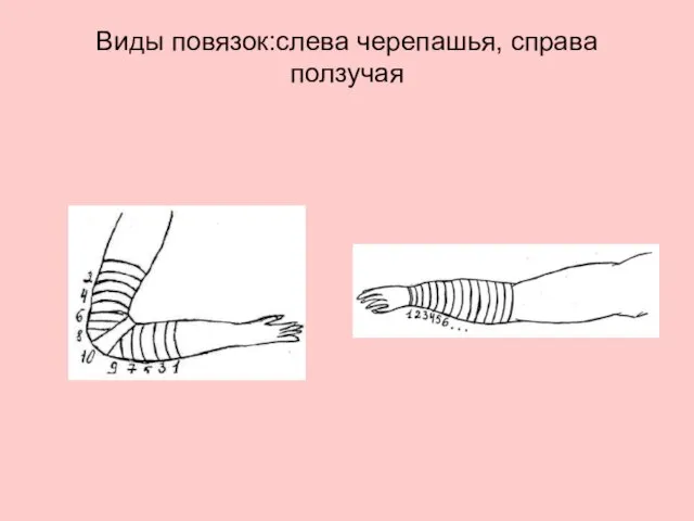 Виды повязок:слева черепашья, справа ползучая