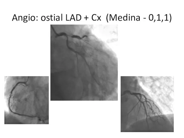 Angio: ostial LAD + Cx (Medina - 0,1,1)