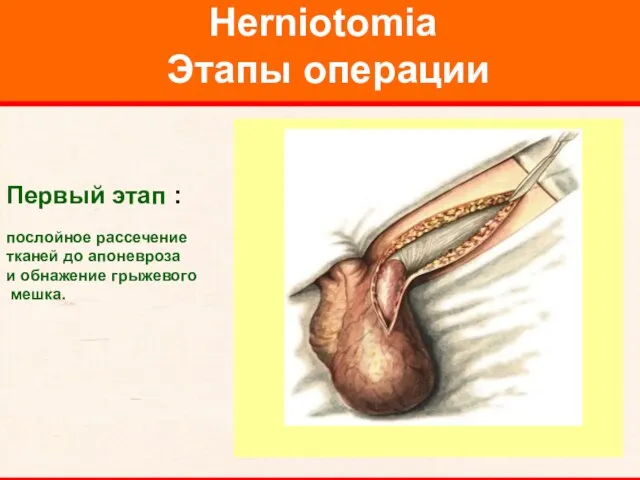 Herniotomia Этапы операции Первый этап : послойное рассечение тканей до апоневроза и обнажение грыжевого мешка.