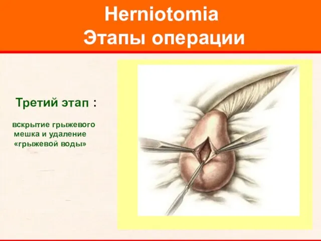 Herniotomia Этапы операции Третий этап : вскрытие грыжевого мешка и удаление «грыжевой воды»