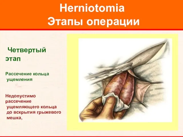 Herniotomia Этапы операции Четвертый этап Рассечение кольца ущемления Недопустимо рассечение ущемляющего кольца до вскрытия грыжевого мешка,