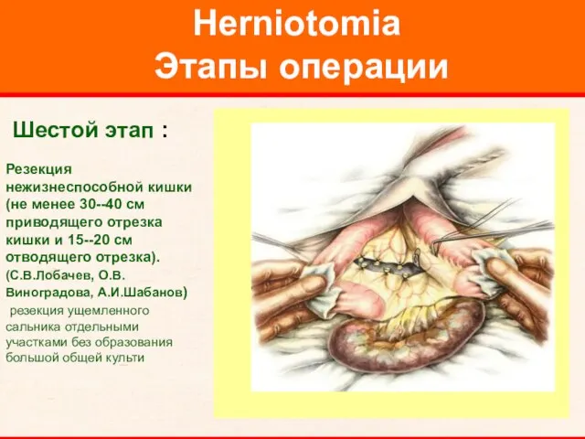 Herniotomia Этапы операции Шестой этап : Резекция нежизнеспособной кишки (не менее 30--40