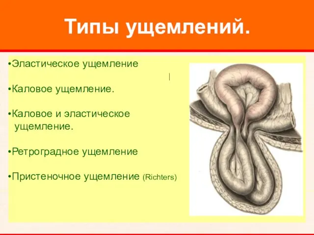 Типы ущемлений. Эластическое ущемление Каловое ущемление. Каловое и эластическое ущемление. Ретроградное ущемление Пристеночное ущемление (Richters)