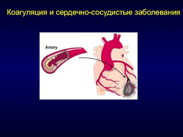 Коагуляция и сердечно-сосудистые заболевания