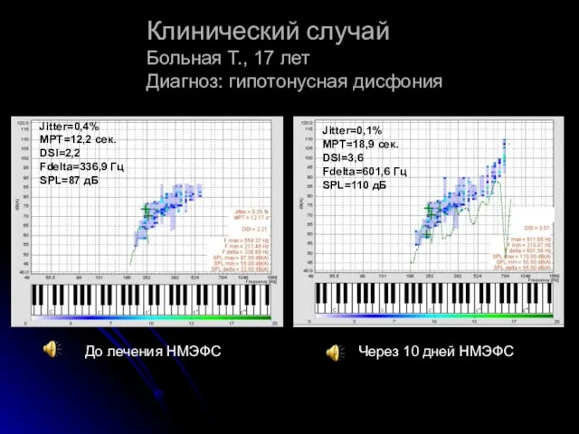 Клинический случай Больная Т., 17 лет Диагноз: гипотонусная дисфония До лечения НМЭФС