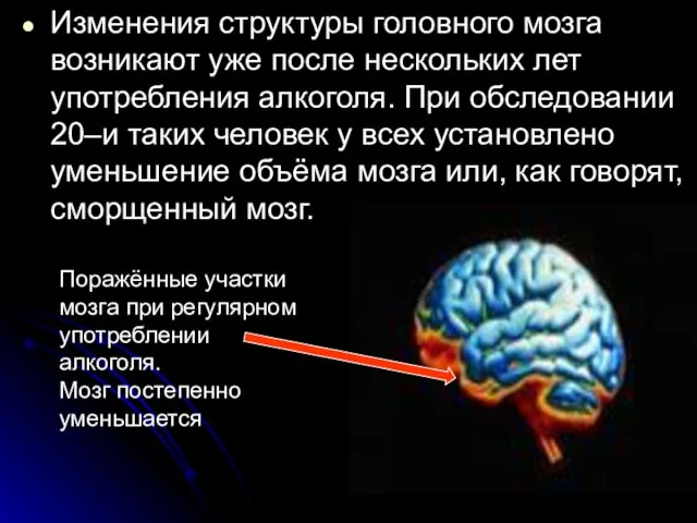 Изменения структуры головного мозга возникают уже после нескольких лет употребления алкоголя. При