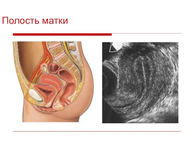 Полость матки