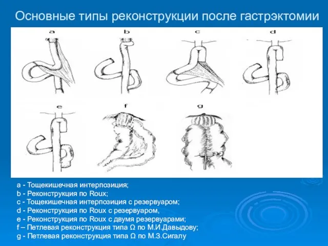 Основные типы реконструкции после гастрэктомии a - Тощекишечная интерпозиция; b - Реконструкция