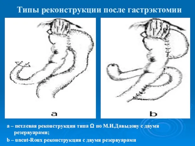 Типы реконструкции после гастрэктомии а – петлевая реконструкция типа Ω по М.И.Давыдову
