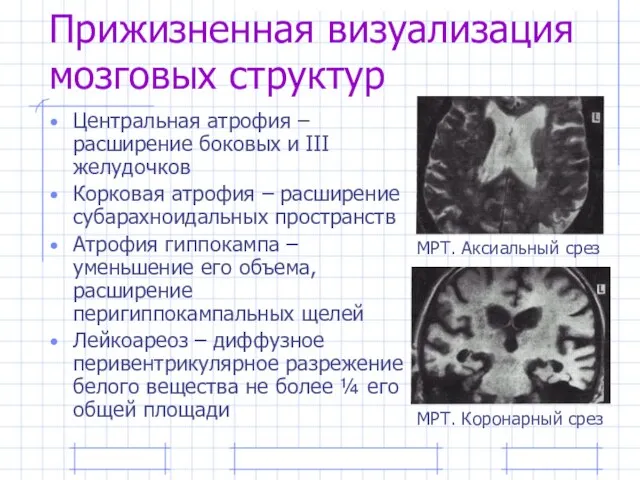 Прижизненная визуализация мозговых структур Центральная атрофия – расширение боковых и III желудочков