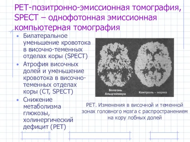 РЕТ-позитронно-эмиссионная томография, SPECT – однофотонная эмиссионная компьютерная томография Билатеральное уменьшение кровотока в