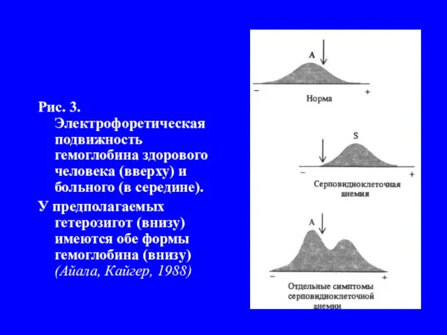 Рис. 3. Электрофоретическая подвижность гемоглобина здорового человека (вверху) и больного (в середине).