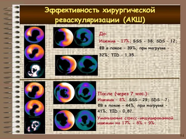 Эффективность хирургической реваскуляризации (АКШ) 54 До: Ишемия – 17%; SSS - 38;