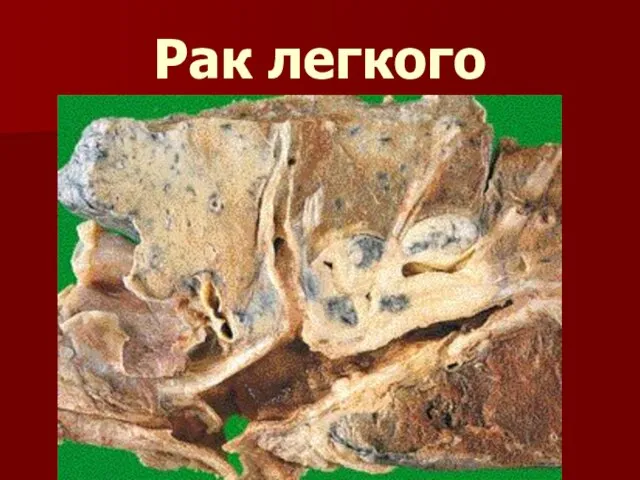 Рак легкого