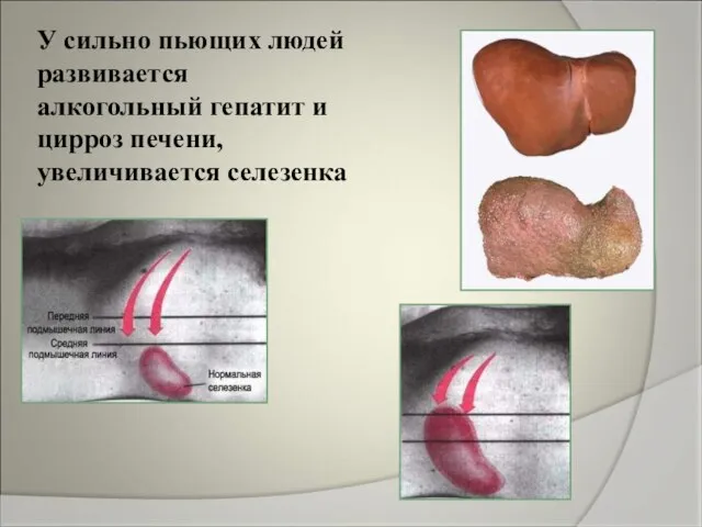 У сильно пьющих людей развивается алкогольный гепатит и цирроз печени, увеличивается селезенка