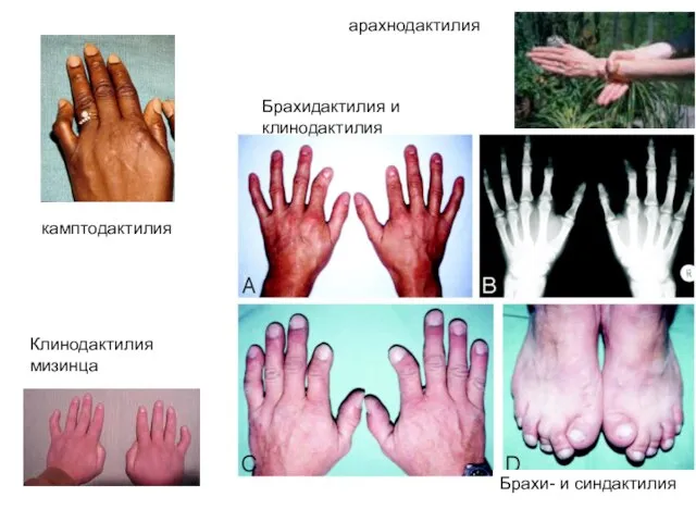 Клинодактилия мизинца арахнодактилия камптодактилия Брахидактилия и клинодактилия Брахи- и синдактилия