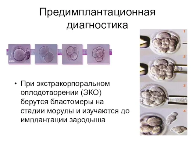 Предимплантационная диагностика При экстракорпоральном оплодотворении (ЭКО) берутся бластомеры на стадии морулы и изучаются до имплантации зародыша