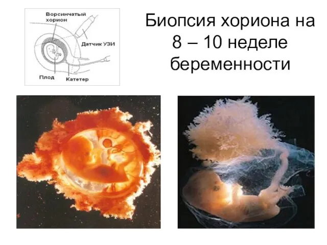 Биопсия хориона на 8 – 10 неделе беременности