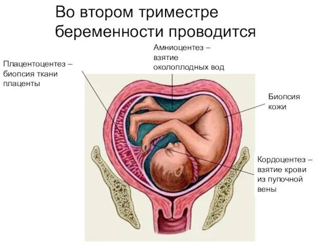 Кордоцентез – взятие крови из пупочной вены Амниоцентез – взятие околоплодных вод