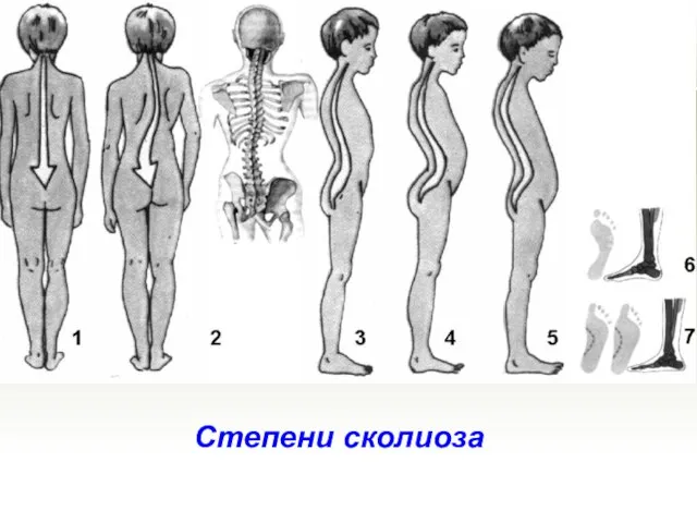 Степени сколиоза Степени сколиоза