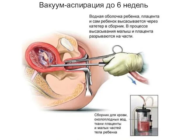 Вакуум-аспирация до 6 недель