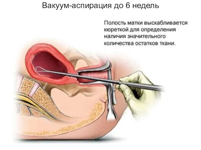 Вакуум-аспирация до 6 недель