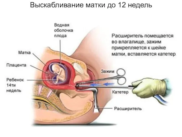 Выскабливание матки до 12 недель