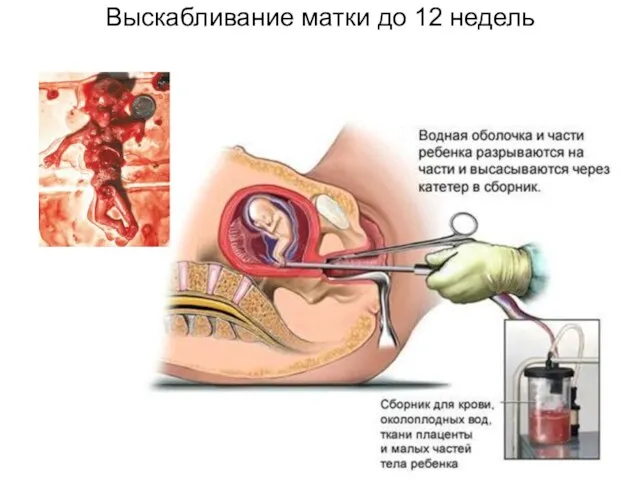 Выскабливание матки до 12 недель