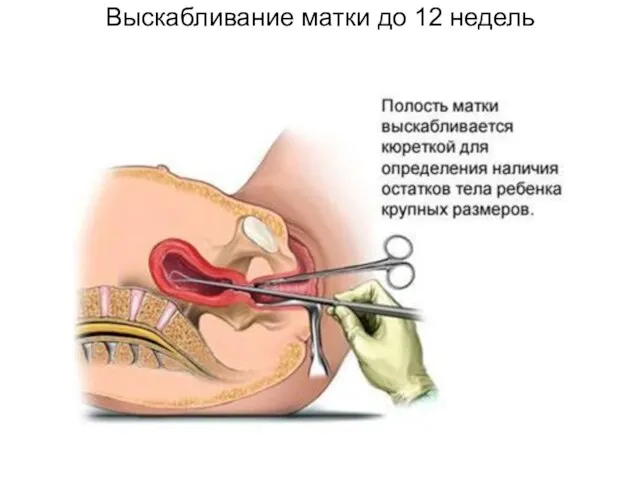 Выскабливание матки до 12 недель