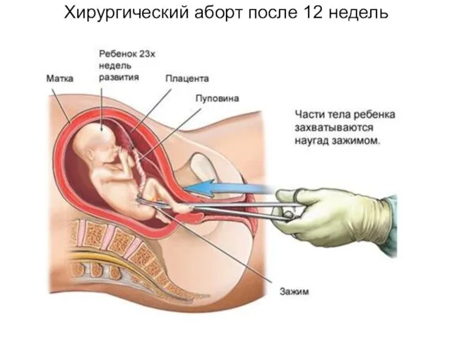 Хирургический аборт после 12 недель