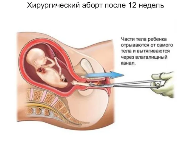 Хирургический аборт после 12 недель