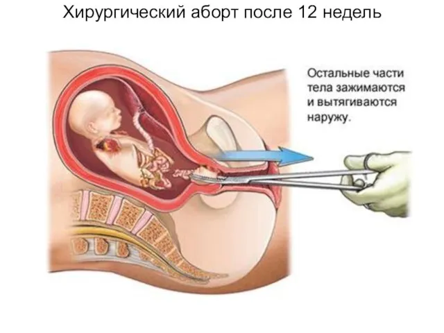 Хирургический аборт после 12 недель