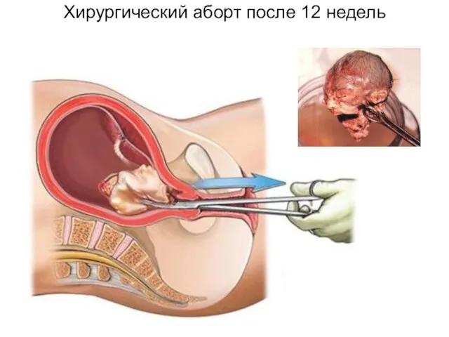Хирургический аборт после 12 недель