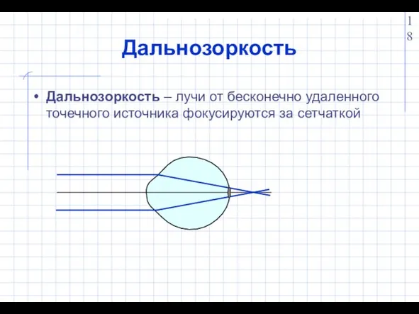 Дальнозоркость Дальнозоркость – лучи от бесконечно удаленного точечного источника фокусируются за сетчаткой