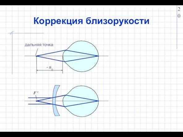 Коррекция близорукости