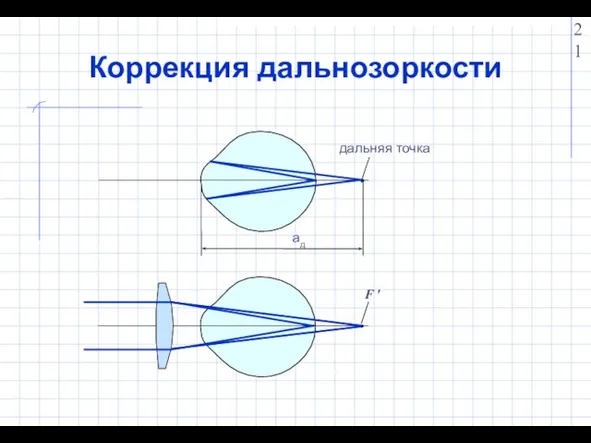 Коррекция дальнозоркости дальняя точка aд