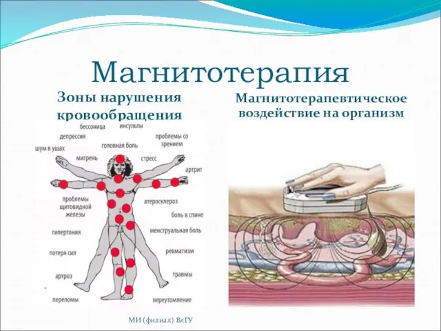 Магнитотерапия Зоны нарушения кровообращения Магнитотерапевтическое воздействие на организм МИ (филиал) ВлГУ