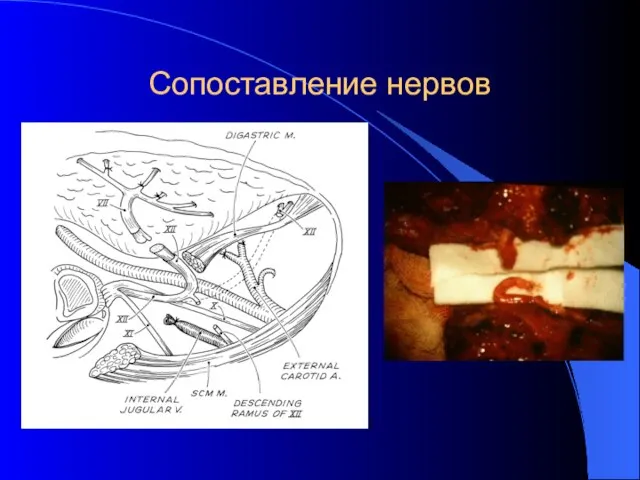 Сопоставление нервов