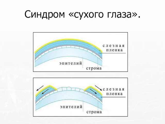 Синдром «сухого глаза».