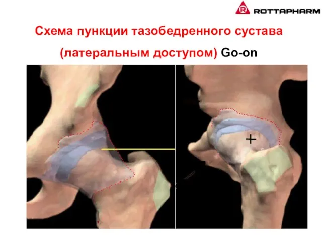 Схема пункции тазобедренного сустава (латеральным доступом) Go-оn