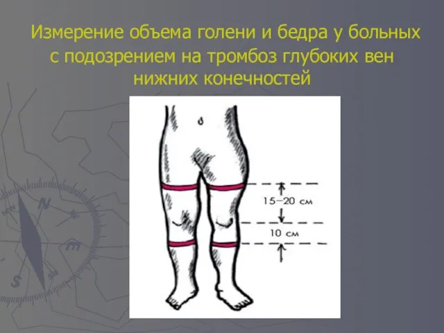 Измерение объема голени и бедра у больных с подозрением на тромбоз глубоких вен нижних конечностей