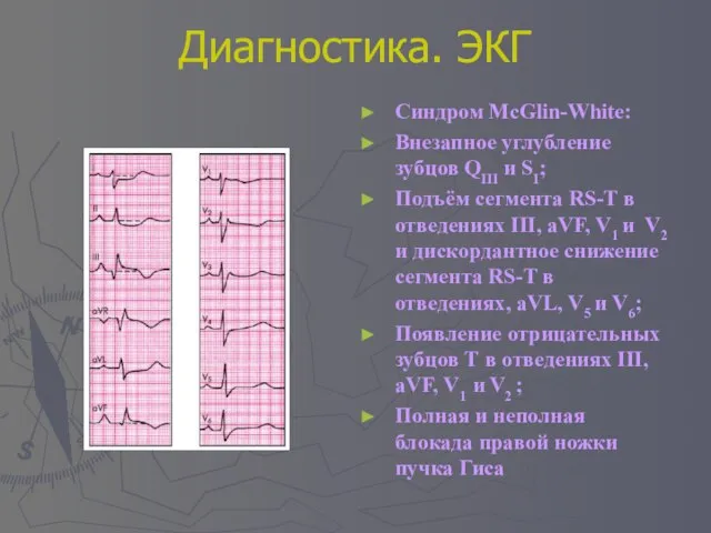 Диагностика. ЭКГ Синдром McGlin-White: Внезапное углубление зубцов QIII и SI; Подъём сегмента