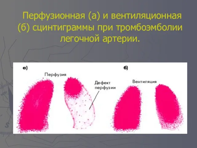 Перфузионная (а) и вентиляционная (б) сцинтиграммы при тромбоэмболии легочной артерии.